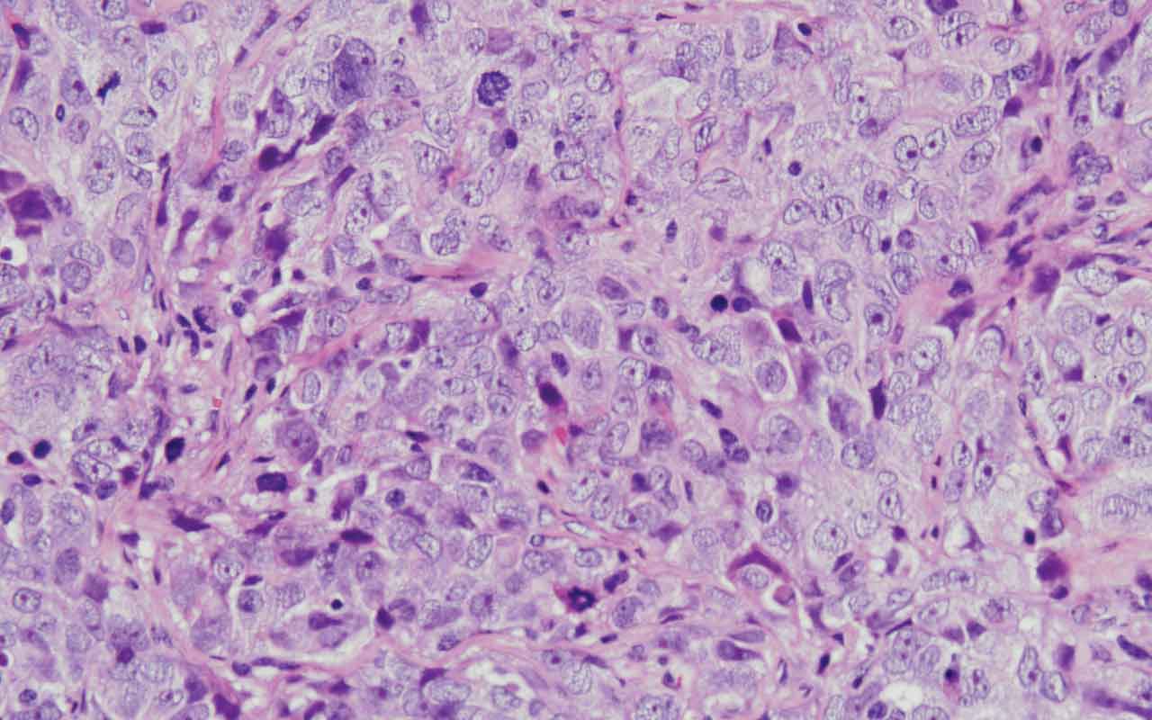 Identificada una vía molecular implicada en el cáncer de ovario y en la generación de resistencias ante la enfermedad