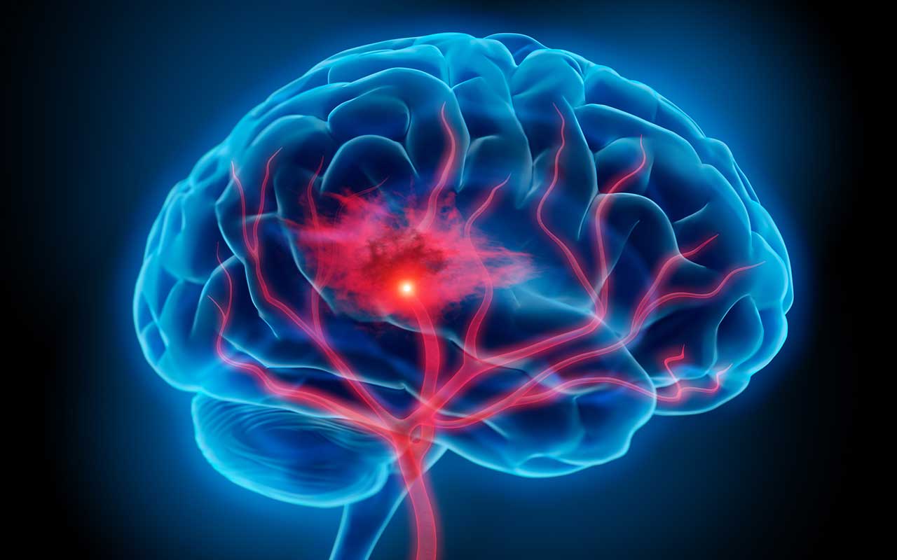 Una nueva técnica biomatemática permite monitorizar con precisión la evolución del daño cerebral en accidentes cerebrovasculares