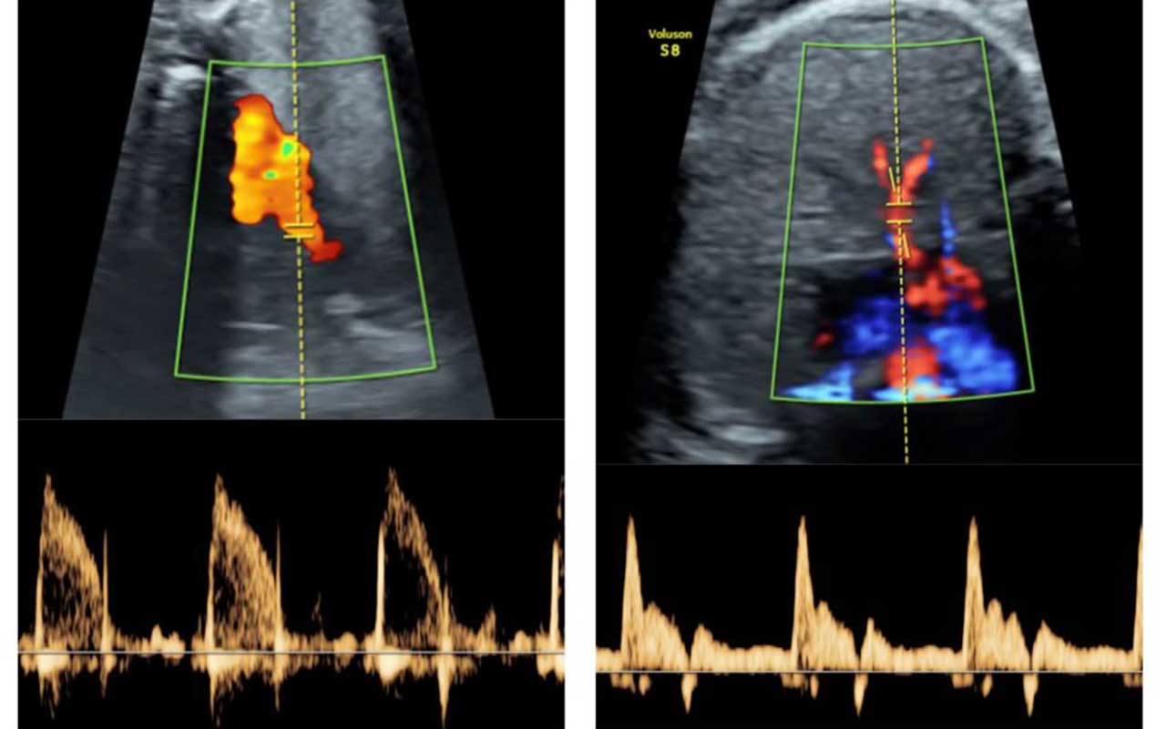 Un estudio de la UPF y BCNatal abre la puerta al diseño de terapias para mejorar el desarrollo pulmonar de fetos demasiado pequeños