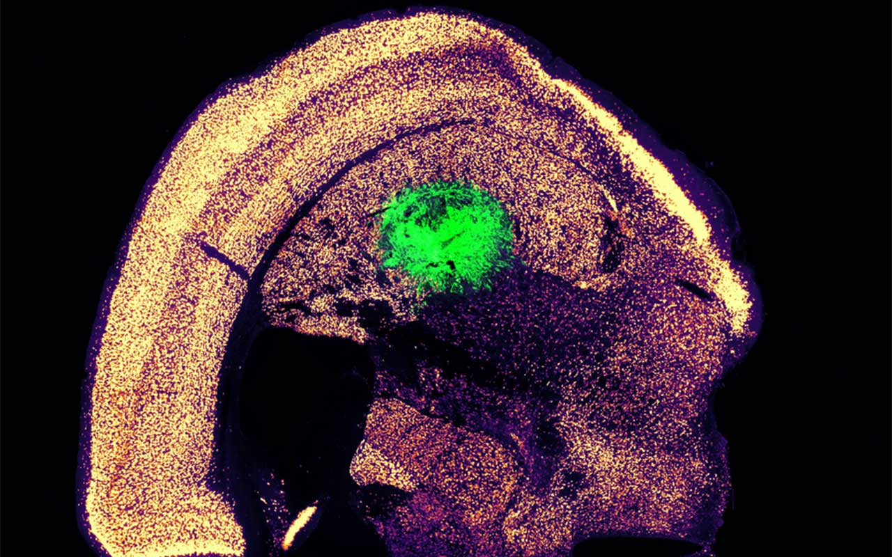 MIT engineers turn skin cells directly into neurons for cell therapy