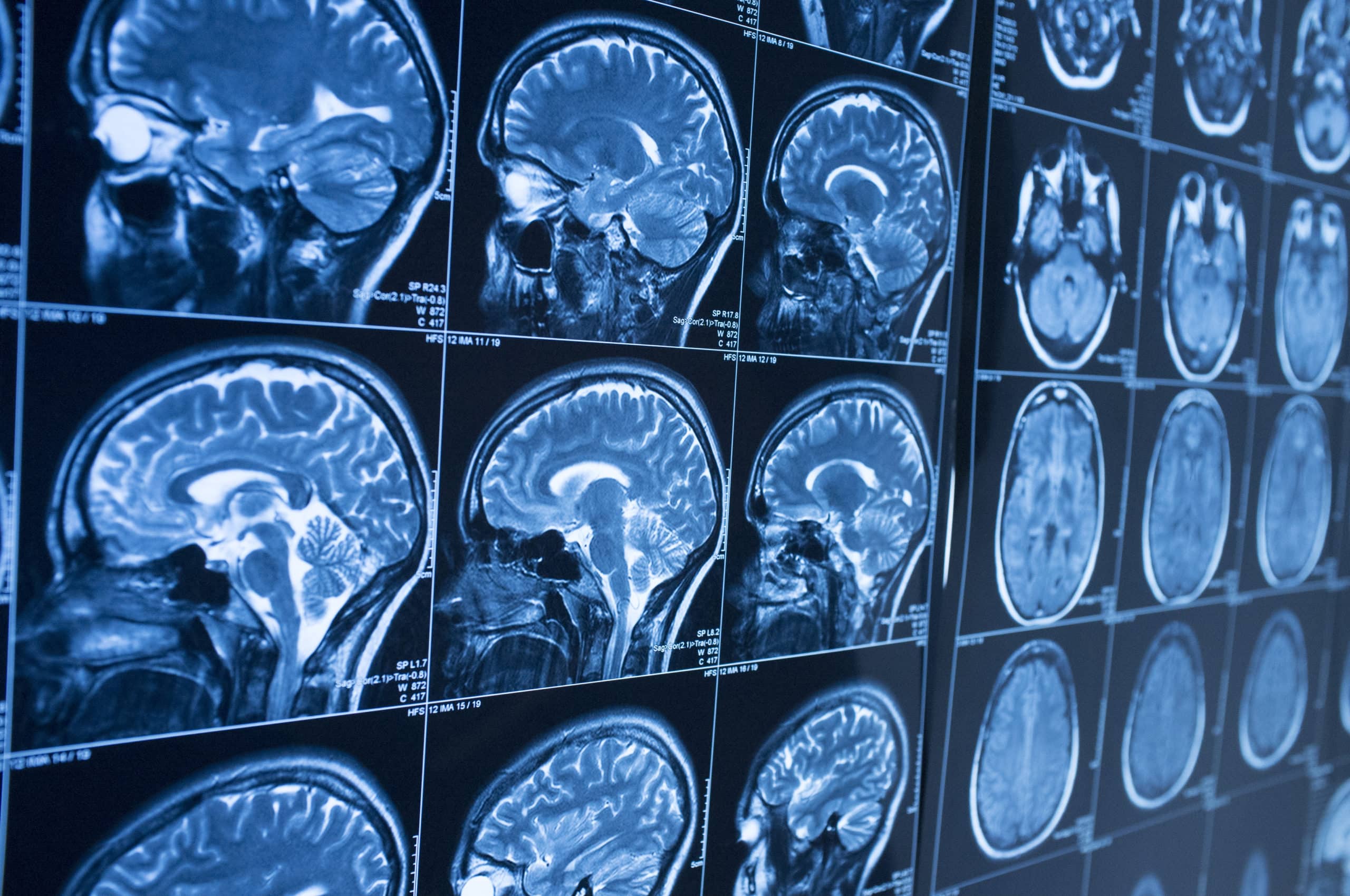 Un método basado en inteligencia artificial reduce un 90% el tiempo para obtener resonancias magnéticas