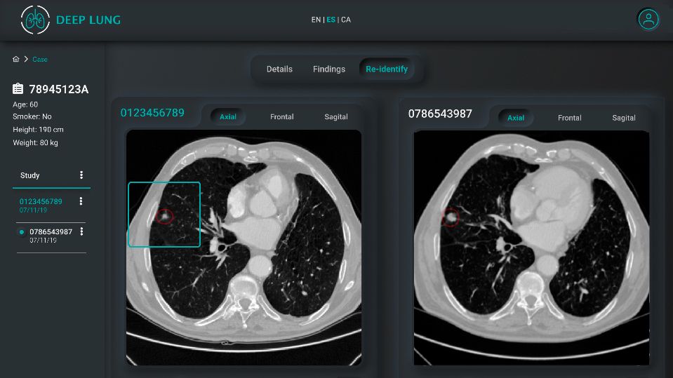 El MWC muestra un nuevo sistema para identificar nódulos indicadores de posibles cánceres pulmonares mediante Inteligencia Artificial