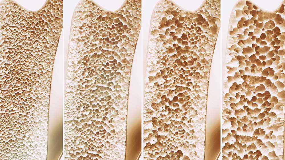 Nueva alternativa farmacológica para la osteoporosis grave