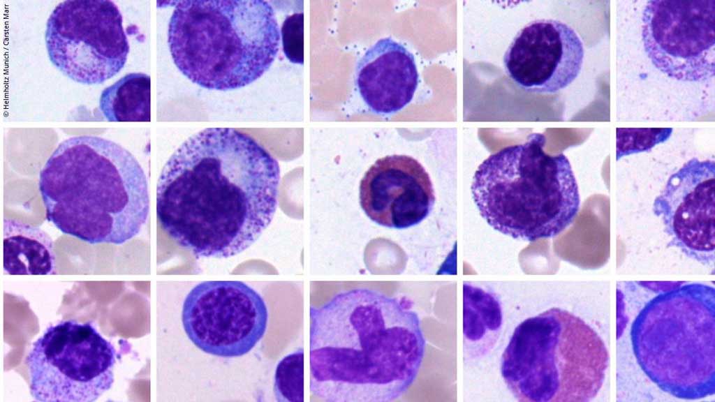 Fighting blood diseases with AI