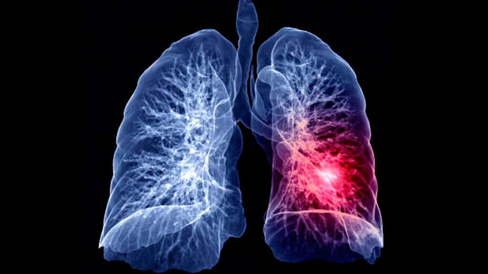 Nanoparticle therapeutic enhances cancer immunotherapy