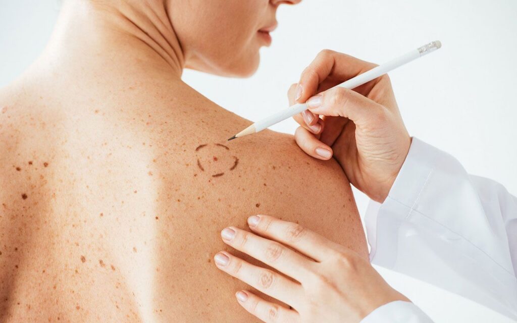 The application of space technology in the monitoring of pigmented skin lesions will enable early detection of melanomas