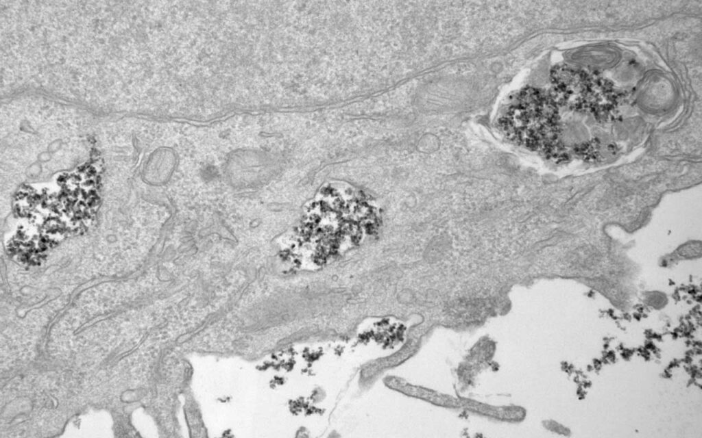 Nanopartículas magnéticas metálicas para liberar fármacos de forma dirigida y para tratar tumores