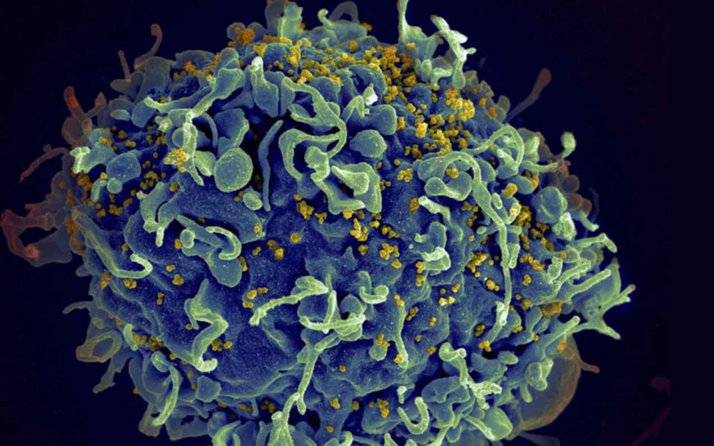 First case of HIV cure in a woman after stem cell transplantation reported at CROI-2022