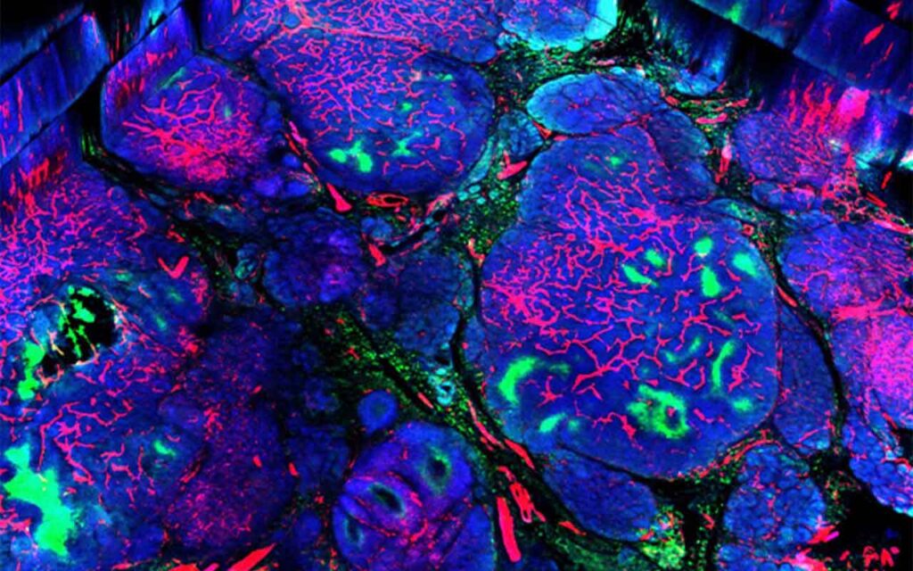 Identificada una nueva diana para el tratamiento de cáncer de mama