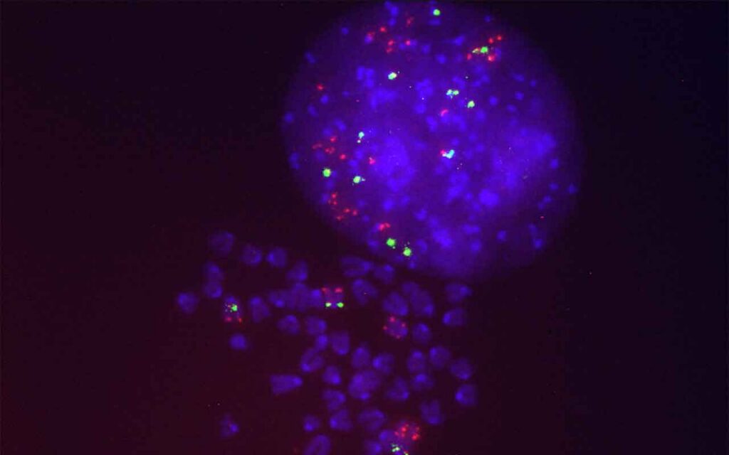 Hallan los mecanismos que provocan la resistencia al tratamiento de cáncer de pulmón con un inhibidor del gen KRAS