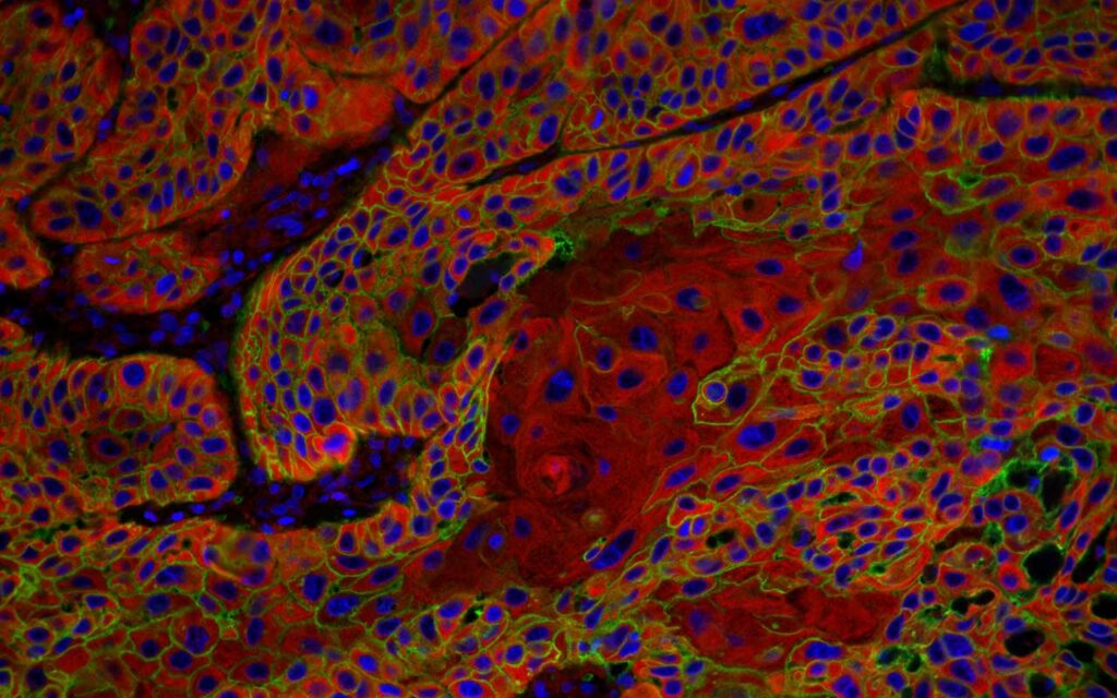 Estudio para mejorar el tratamiento contra el cáncer