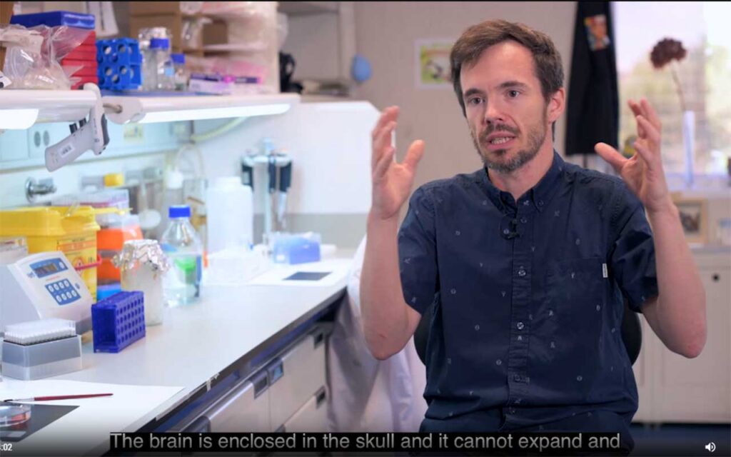 Un estudio pionero descubre que los tumores cerebrales ‘hackean’ la comunicación entre las neuronas