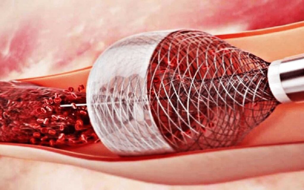 Expertos destacan la eficacia de la trombectomía percutánea para el tratamiento de la embolia pulmonar: efecto inmediato, menos riesgos de complicaciones y recuperación más rápida