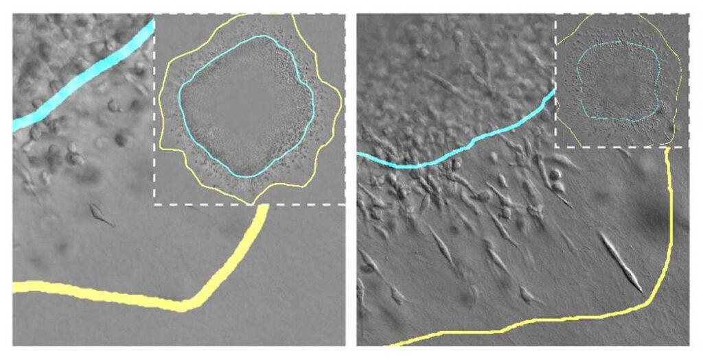 Crean un modelo computacional que simula el crecimiento biomecánico de los tumores de mama
