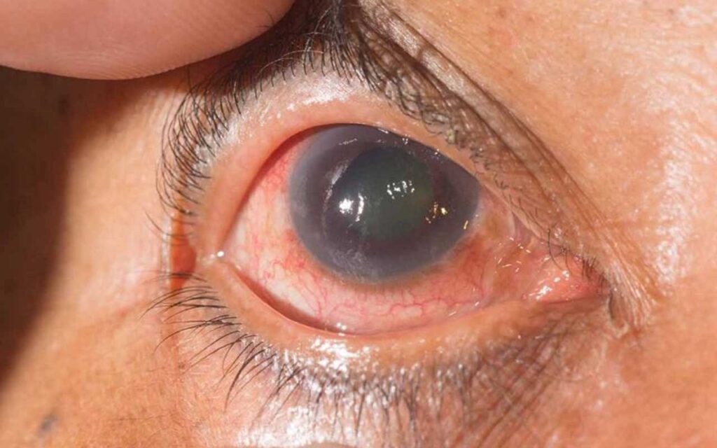 Un fármaco descubierto como protector renal obtiene resultados prometedores en glaucoma
