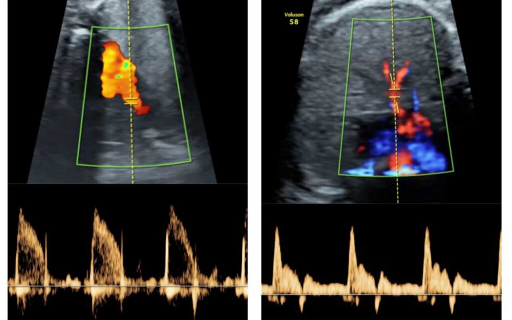 Un estudio de la UPF y BCNatal abre la puerta al diseño de terapias para mejorar el desarrollo pulmonar de fetos demasiado pequeños