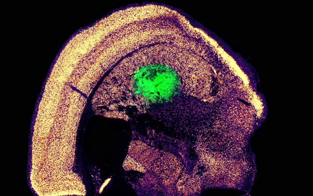 MIT's neuron conversion process enhances spinal cord and ALS treatments