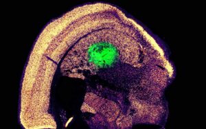 MIT's neuron conversion process enhances spinal cord and ALS treatments