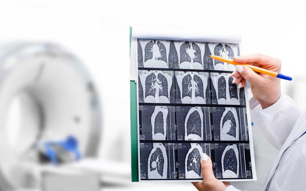 GMV diseña un innovador simulador basado en inteligencia artificial para diagnosticar enfermedades pulmonares intersticiales