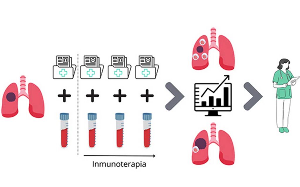 Algoritmo IA predice respuesta a inmunoterapia en cáncer de pulmón usando datos clínicos
