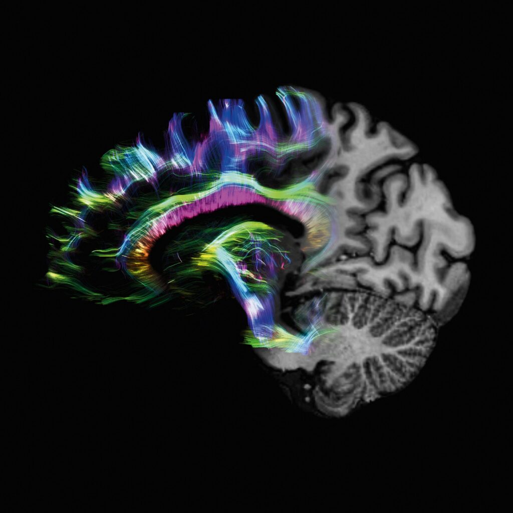 Las técnicas de imagen médica abren nuevas vías para detectar el Alzhéimer en fases preclínicas