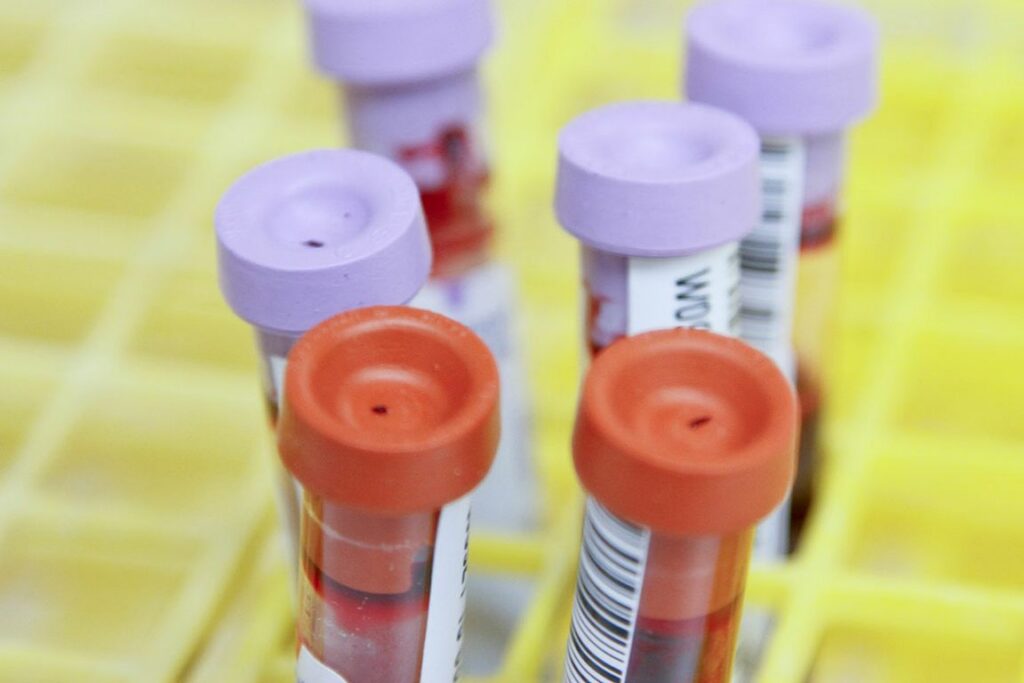 New blood test for early detection of amyotrophic lateral sclerosis