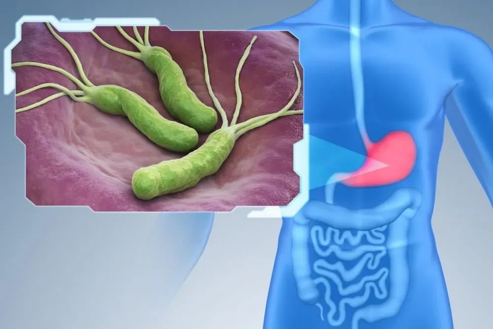 Un método predice la resistencia a antibióticos de una bacteria estomacal que porta la mitad de la población mundial
