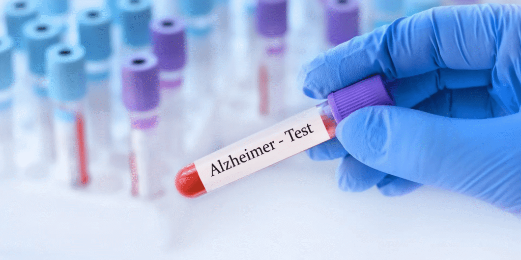 Spotting Alzheimer’s early with a simple blood test