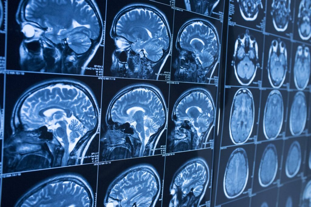 Un método basado en inteligencia artificial reduce un 90% el tiempo para obtener resonancias magnéticas