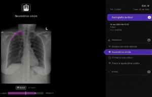 Telefónica y Harrison.ai se alían para apoyar el diagnóstico en radiografías de tórax con IA