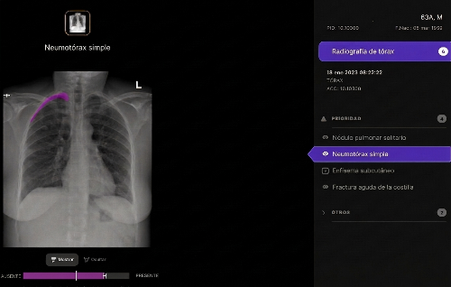 Telefónica y Harrison.ai se alían para apoyar el diagnóstico en radiografías de tórax con IA